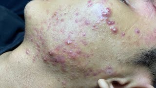 ACNE TREATMENT VU QUYNH MI Blackheads On Boy Face 2024 [upl. by Aisile]