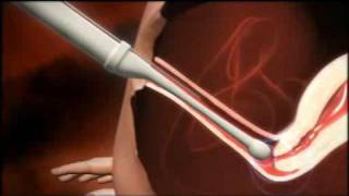 3D animation of how IVF works [upl. by Hachmann]