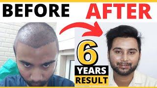 A Hair Transplant Result Booster  How Finasteride Helped Me Maintaining My Hair Transplant Result [upl. by Ociral87]