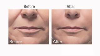 Botox vs Dermal Fillers [upl. by Alberta213]