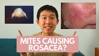 MANAGEMENT OF ROSACEA [upl. by Clercq]