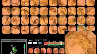 WEO Video Capsule Endoscopy VCE Library clinical case 55 [upl. by Caty]