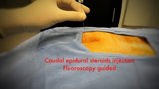 caudal epidural steroids injection fluoroscopystep by step [upl. by Ilojne]