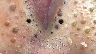 Big Cystic Acne Blackheads Extraction Blackheads amp Milia Whiteheads Removal Pimple Popping  6656 [upl. by Mueller555]