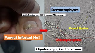 Fungal Infected Nail Microscopy showing Hyphae and Chlamydospores of Dermatophytes [upl. by Choong]