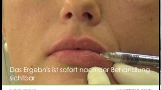 Lippen aufspritzen  Lippenaufspritzung  aesthetic LOUNGE  Dr Yusuf Yildrim [upl. by Lawtun]