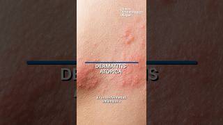 Dermatitis atopica dermatologia [upl. by Linn]