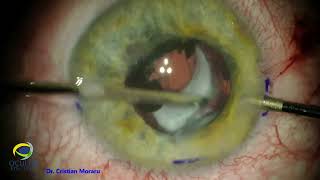 PCIOL secondary implantation in aphakic eye with history of trauma and traumatic cataract surgery [upl. by Hayifas]