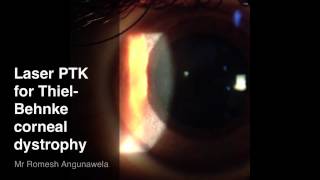 Laser PTK for Anterior Stromal Corneal Dystrophy [upl. by Yelsa502]