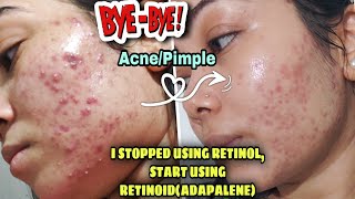 DERMATOLOGIST RECOMMEND ADAPALENE GEL 01 FOR ACNEADAPALENE BEFORE amp AFTERDIFFERIN GEL RESULTS [upl. by Fransis]