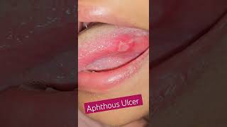 Aphthous Ulcer spotdiagnosis [upl. by Itsym]