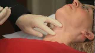 Laryngeal Botox Injection  Dr Ekbom at Mayo Clinic [upl. by Acinoryt]