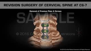 Revision Surgery of Cervical Spine at C67 [upl. by Amol]