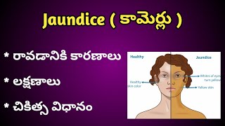 Jaundice  పచ్చ కామెర్లు  Causes Symptoms and Treatment in Telugu [upl. by Euqinue447]