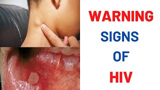 What are the earliest symptoms of HIV [upl. by Alexina]