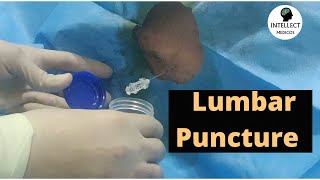 Lumbar puncture LP procedure  Spinal fluid tap [upl. by Bernadette]