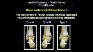 Ankle Fractures Danis Weber Classification  Everything You Need To Know  Dr Nabil Ebraheim [upl. by Clementia]