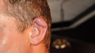 What Is Cauliflower Ear  Ear Problems [upl. by Farkas443]