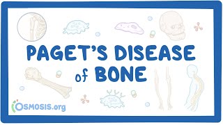 Paget disease of bone [upl. by Lucilla]