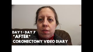 Post Coronectomy Video Diary Day 1 to Day 7 [upl. by Roxy]