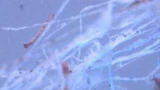 Morgellons In Chemtrails PROVEN [upl. by Aidnahs]