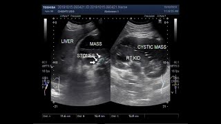 Ultrasound Video showing Cystic lesions in perinephric space known as lymphangiectasia [upl. by Gillman]