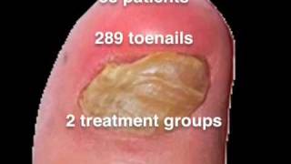 Nail Lacquer Shown Effective for Toenail Fungus [upl. by Adnolehs]