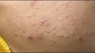 Remove hidden acne on the jaw Nở P1 HoangMySpa55 [upl. by Annohsal]