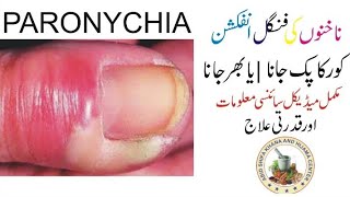 Ungli Ka Pakna  Ungli Ka Pak Jana How To Treat Paronychia  What is Paronychia [upl. by Dlorah]