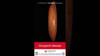 Stargardts Disease retinaspecialist retinadystrophyretina eyeeducation eyes eyespecialist [upl. by Ramirolg170]