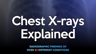 Chest Xrays Explained [upl. by Dulciana]