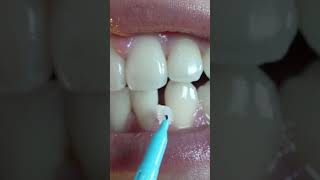 How to use interdental brushes [upl. by Shaughn]