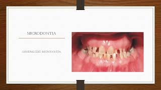 What is Microdontia  small teeth By DrAmin [upl. by Oizirbaf]