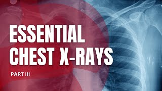 Essential Chest Xrays for Students Part III [upl. by Gustafsson]