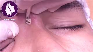 Blackheads Removal On Forehead  Get rid of Pimples  16 [upl. by Palmore]