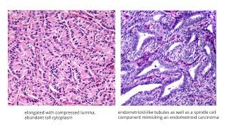 Sertoli cell tumorGYNpath [upl. by Goodman]