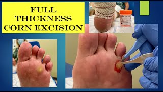 video  full thickness corn excision [upl. by Yblek]