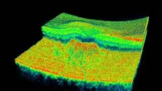 Topcon 3D OCT  Soft Drusen [upl. by Aicat]