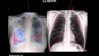 Pneumonia Imaging [upl. by Irwinn517]