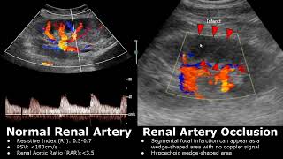 Renal Artery Doppler Ultrasound Normal Vs Abnormal Images  StenosisOcclusionAVM  Kidney USG [upl. by Nylesor139]