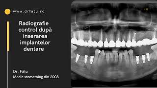 Caz clinic implanturi dentare si coroane [upl. by Otineb510]