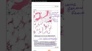 APLASTIC ANEMIA PATHOLOGY [upl. by Fabiano]