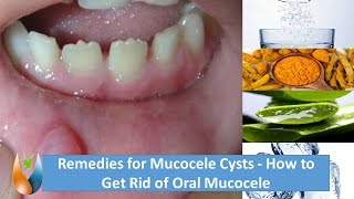 Remedies for Mucocele Cysts  How to Get Rid of Oral Mucocele [upl. by Enomal]