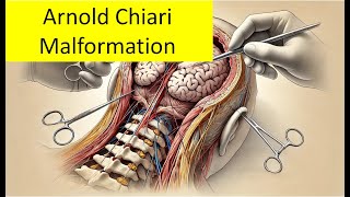 Arnold Chiari Malformation [upl. by Yddeg231]