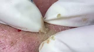 INFLAMED CYSTIC ACNE Extraction Blackheads Whiteheads Milia [upl. by Eikcid]