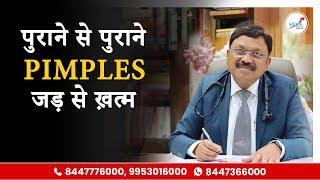 मुँहासे खत्म करने का रामबाण इलाज  How To Remove Pimples Overnight  Acne Treatment amp Medicines [upl. by Queri]