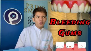 BLEEDING GUMS Normal ba Gingivitis [upl. by Ahcsim]