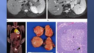 solid tumors of the peritoneum omentum and mesentery [upl. by Sessler]