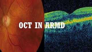 OCT in AMD Age related macular degeneration [upl. by Ayotan]