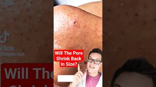 Standout BLACKHEAD REMOVAL  How To Shrink Pores shorts [upl. by Cob]